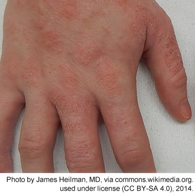 Skin Diseases: Skin Health and Skin Diseases - MedlinePlus